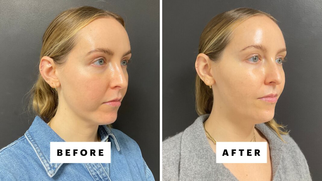 I Got Chin Filler for the First Time—Here’s What Happened (Before-and-After Photos)