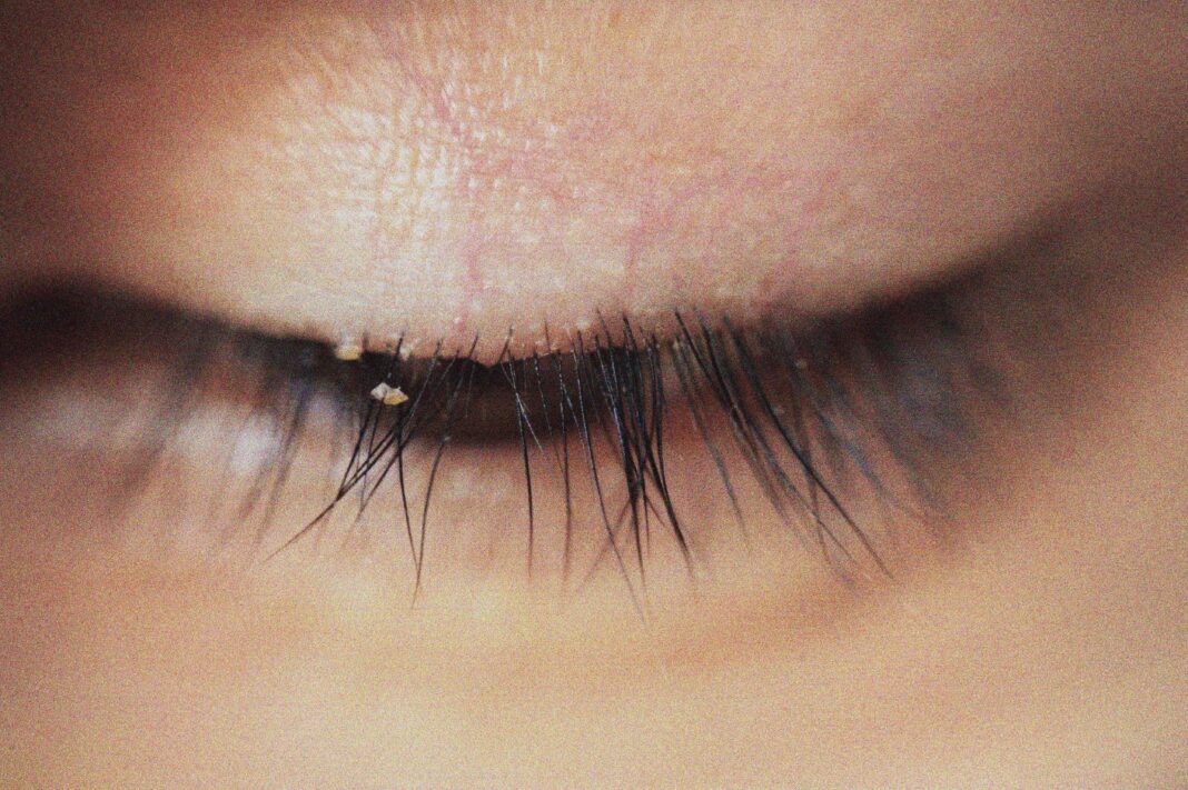 Demodex Mites in Eyes: Symptoms, Causes, and Effective Treatments