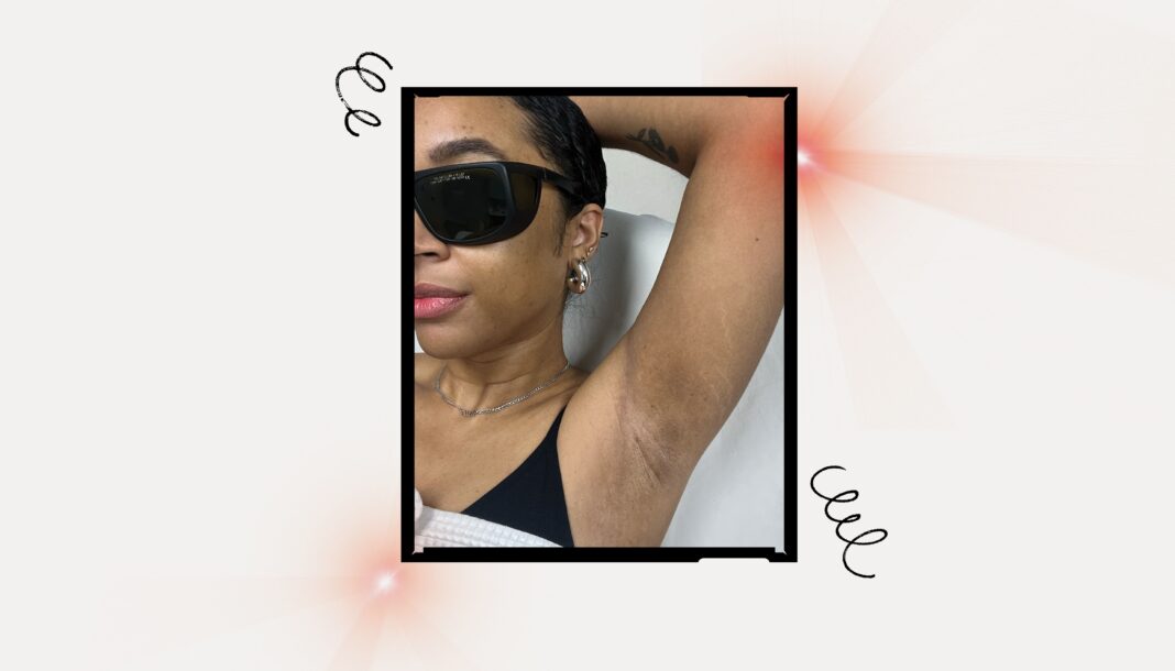How I’m Preventing Hyperpigmentation During Laser Hair Removal