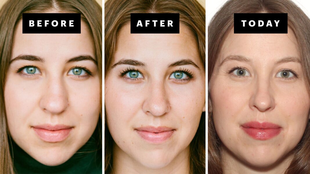 My Rhinoplasty Journey at 25 | Nose Before and After Photos