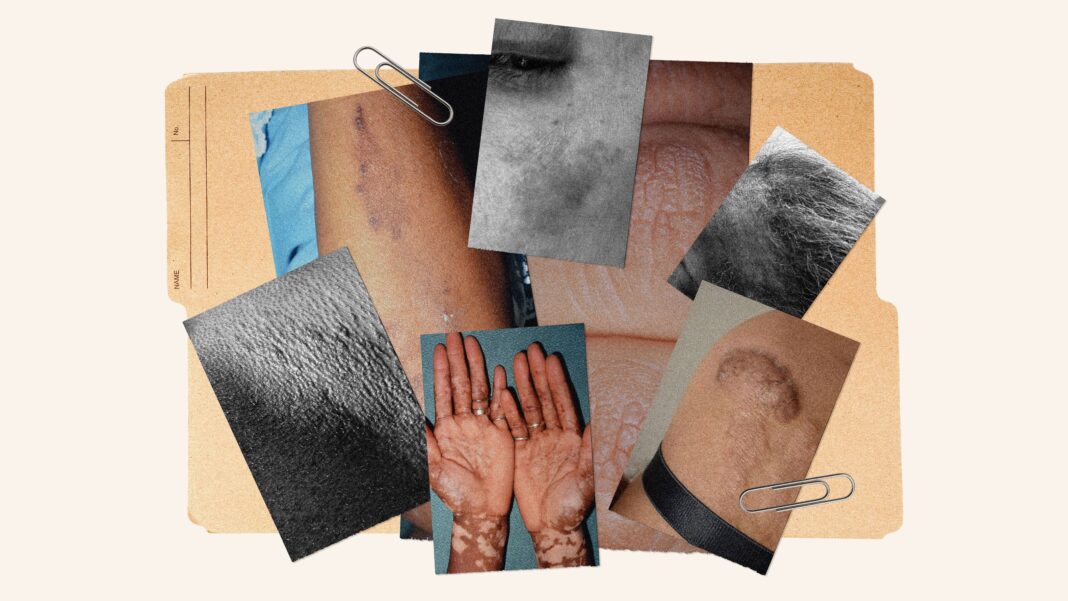 11 Common Skin Conditions on Dark Skin: Causes, Treatments, and Prevention Tips