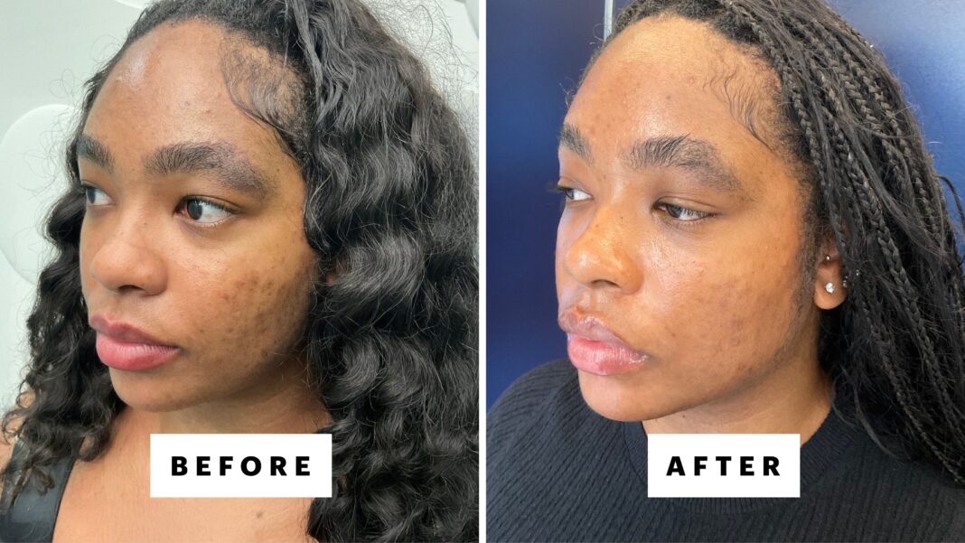 Is Laser Genesis Worth the Hype for Your Skin?