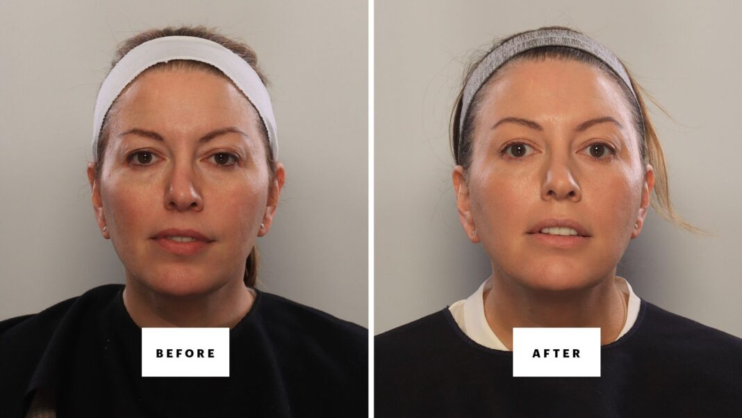 Blepharoplasty in a Bottle? I Tested Every Non-Surgical Shortcut.