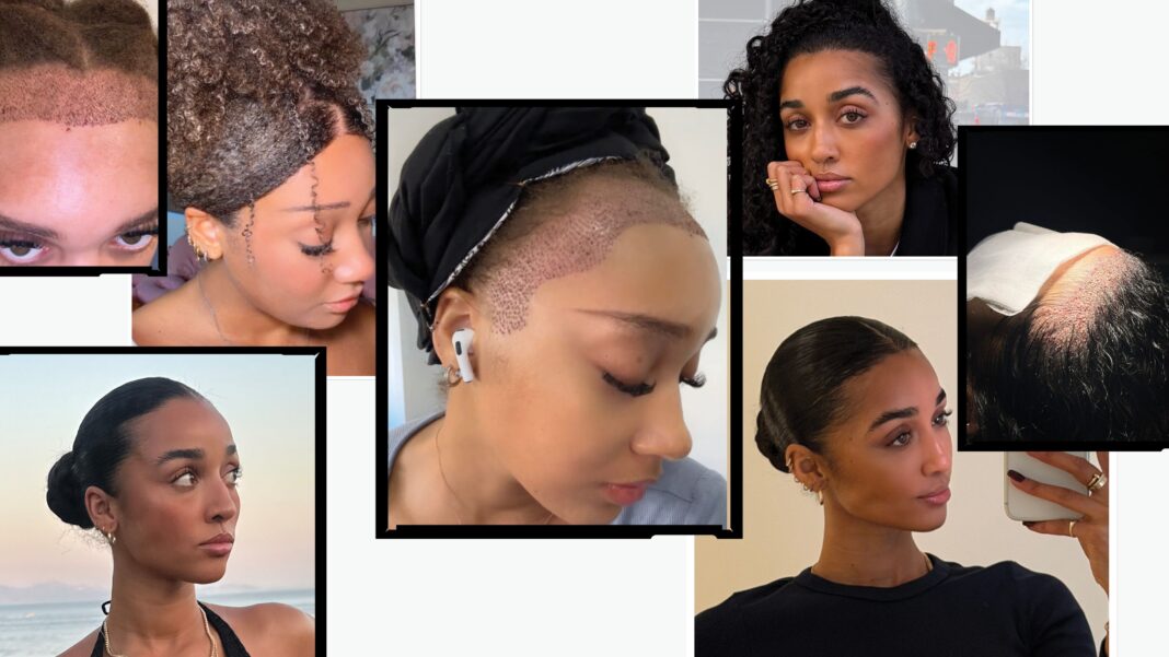 More Women Are Turning to Turkey for Hair Transplants